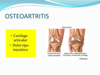 OSTEOARTRITIS
 Cartílago
articular
 Dolor tipo
mecánico
 
