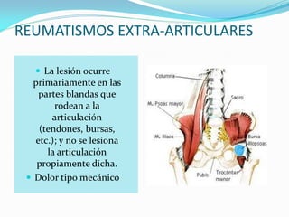 REUMATISMOS EXTRA-ARTICULARES
 La lesión ocurre
primariamente en las
partes blandas que
rodean a la
articulación
(tendones, bursas,
etc.); y no se lesiona
la articulación
propiamente dicha.
 Dolor tipo mecánico
 