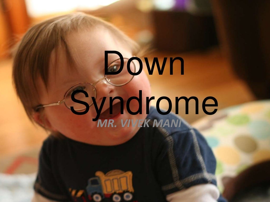 Down Syndrome Ppt Free Download
