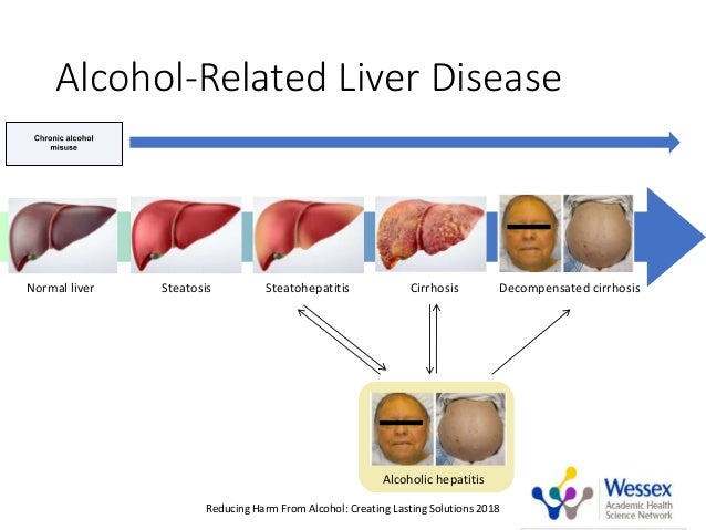 Integrated alcohol treatment for alcohol related liver disease