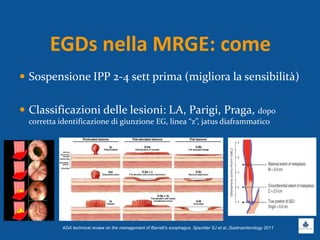 EGDs nella MRGE: come
 Sospensione IPP 2-4 sett prima (migliora la sensibilità)
 Classificazioni delle lesioni: LA, Parigi, Praga, dopo
corretta identificazione di giunzione EG, linea “z”, jatus diaframmatico
AGA technical review on the management of Barrett’s esophagus. Spechler SJ et al.,Gastroenterology 2011
 