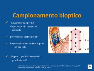 Campionamento bioptico
 rinviare biopsie per EB
dopo terapia in presenza di
esofagite
 protocollo di Seattle per EB
 biopsie distinte in esofago sup. ed
inf. per EoE
 biopsie G per Hp sempre o in
pz selezionati?
AGA technical review on the management of Barrett’s esophagus. Spechler SJ et al.,Gastroenterology 2011
Endoscopic mucosal tissue sampling, ASGE GL 2013
 