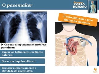 O pacemaker
É colocado sob a peleabaixo da clavícula.
É colocado sob a peleabaixo da clavícula.
Captar os batimentos cardíacos
naturais.
Gerar um impulso elétrico.
Registar eletronicamente a
atividade do pacemaker.
 Os seus componentes eletrónicos
permitem:
 