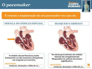 O pacemaker
O nódulo sinusal funciona muito
lentamente ou não aumenta a frequência
em resposta ao exercício.
SINTOMAS:
tonturas, desmaios e falta de ar...
É comum a implantação de um pacemaker em caso de:É comum a implantação de um pacemaker em caso de:
DOENÇA DO NÓDULO SINUSAL BLOQUEIO CARDÍACO
Os sinais provenientes do nódulo
sinusal são completamente
bloqueados ou sofrem um atraso
significativo.
SINTOMAS:
tonturas, desmaios e falta de ar...
X
 