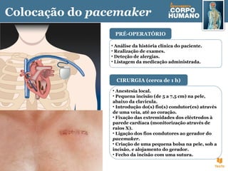 Colocação do pacemaker
• Análise da história clínica do paciente.
• Realização de exames.
• Deteção de alergias.
• Listagem da medicação administrada.
PRÉ-OPERATÓRIO
• Anestesia local.
• Pequena incisão (de 5 a 7,5 cm) na pele,
abaixo da clavícula.
• Introdução do(s) fio(s) condutor(es) através
de uma veia, até ao coração.
• Fixação das extremidades dos eléctrodos à
parede cardíaca (monitorização através de
raios X).
• Ligação dos fios condutores ao gerador do
pacemaker.
• Criação de uma pequena bolsa na pele, sob a
incisão, e alojamento do gerador.
• Fecho da incisão com uma sutura.
CIRURGIA (cerca de 1 h)
 