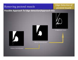 MICROCALCIFICATION IDENTIFICATION IN DIGITAL MAMMOGRAM FOR EARLY ...