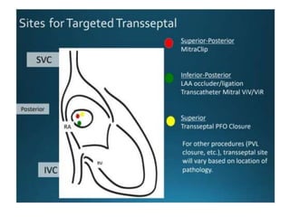 Tmvr Procedure.pdf STEP BY STEP VALVE IN VALVE TMVR | PPTX