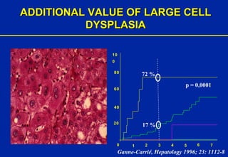 ADDITIONAL VALUE OF LARGE CELL DYSPLASIA p = 0,0001 Ganne-Carrié, Hepatology 1996; 23: 1112-8 7 6   5   4  3   2   1   0   20  40   60   80   100   72 % 17 % 