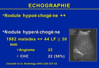 ECHOGRAPHIE Nodule hypoéchogène ++ Nodule hyperéchogène 1982 malades => 44 LF ≤ 30 mm Angiome 22 CHC 22 (50%) Caturelli et al. Radiology 2001;220:337-32 