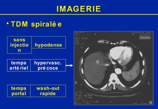 IMAGERIE TDM spiralée sans injection temps artériel temps portal hypervasc. précoce hypodense wash-out rapide 