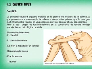 4.2 CAUSES I TIPUS

CAUSES:

La principal causa d' aquesta malaltia es la pressió del estatus de la bellesa, ja
que posen com a exemple de la bellesa a dones altes primes, que fa que gent
molt influenciable l caigui en una obsessió de voler canviar el seu aspecte físic.
Però el seu origen es fonamentalment en la combinació de factors biològic
(canvis físics), psicològics i socials.

Els mes habituals són:
-L' obesitat

-L' obesitat materna

-La mort o malaltia d' un familiar

-Separació del pares

-Fracàs escolar

-Traumes
 