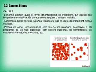 2.2. Causes i tipus

CAUSES:
-L'anèmia apareix quan el nivell d'hemoglobina és insuficient. En aquest cas
l'organisme es debilita. És la causa més freqüent d'aquesta malaltia.
-Alimentació baixa en ferro.Algunes vegades té lloc en dieta d'aprimament massa
estrictes.
-Pèrdua de sang. Circumstàncies com les de mestruacions excessives o els
problemes de les vies digestives (com l'úlcera duodenal, les hemorroides, les
malalties inflamatòries intestinals, etc.)
 