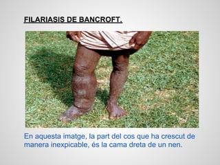 FILARIASIS DE BANCROFT.




En aquesta imatge, la part del cos que ha crescut de
manera inexpicable, és la cama dreta de un nen.
 