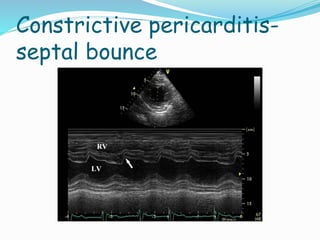 Constrictive pericarditis-
septal bounce
 