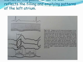 Motion of the posterior aortic wall
reflects the filling and emptying patterns
of the left atrium.
 