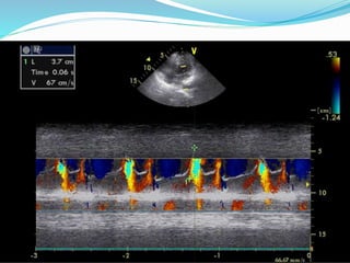 Velocity of propagation
 