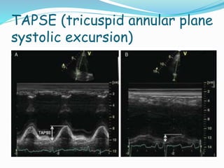 TAPSE (tricuspid annular plane
systolic excursion)
 