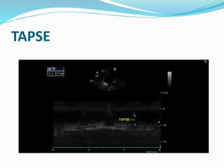 TAPSE
 