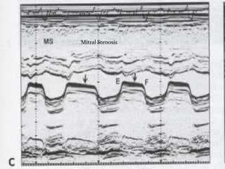 Mitral Stenosis
 