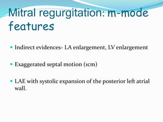 Mitral regurgitation: m-mode
features
 Indirect evidences- LA enlargement, LV enlargement
 Exaggerated septal motion (1cm)
 LAE with systolic expansion of the posterior left atrial
wall.
 