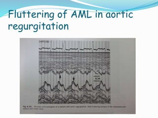 Fluttering of AML in aortic
regurgitation
 