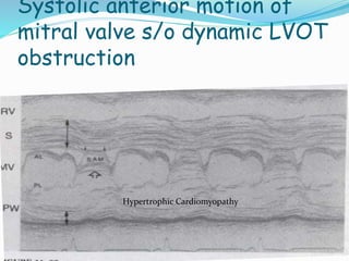 Hypertrophic Cardiomyopathy
Systolic anterior motion of
mitral valve s/o dynamic LVOT
obstruction
 