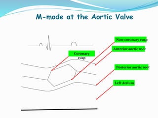 M-mode at the Aortic Valve
Coronary
cusp
Non-coronary cusp
Anterior aortic root
Posterior aortic root
Left Atrium
 