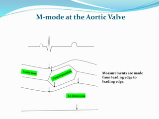 M-mode at the Aortic Valve
LA dimension
Measurements are made
from leading edge to
leading edge.
 