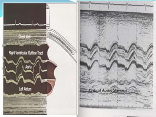 Critical Aortic Stenosis
 