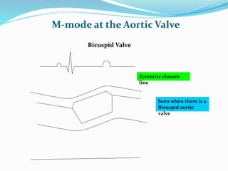 M-mode at the Aortic Valve
Bicuspid Valve
Eccentric closure
line
Seen when there is a
Bicuspid aortic
valve
 