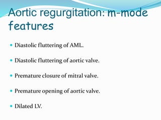 Aortic regurgitation: m-mode
features
 Diastolic fluttering of AML.
 Diastolic fluttering of aortic valve.
 Premature closure of mitral valve.
 Premature opening of aortic valve.
 Dilated LV.
 