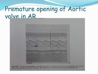 Premature opening of Aortic
valve in AR
 