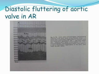 Diastolic fluttering of aortic
valve in AR
 