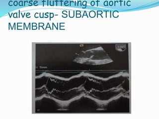 coarse fluttering of aortic
valve cusp- SUBAORTIC
MEMBRANE
 