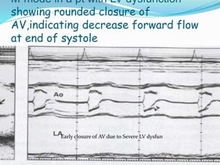 Early closure of AV due to Severe LV dysfun
M-mode in a pt with LV dysfunction-
showing rounded closure of
AV,indicating decrease forward flow
at end of systole
 