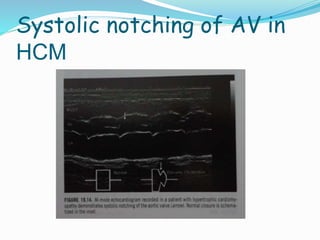 Systolic notching of AV in
HCM
 