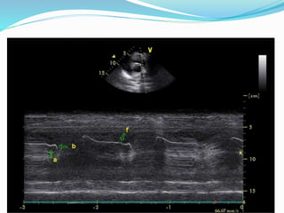 M-mode at Pulmonary valve
 