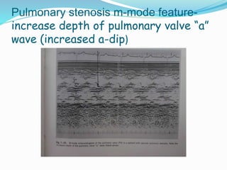 Pulmonary stenosis m-mode feature-
increase depth of pulmonary valve “a”
wave (increased a-dip)
 