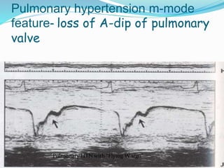 Pulmonary HTN with “Flying W sign”
Pulmonary hypertension m-mode
feature- loss of A-dip of pulmonary
valve
 