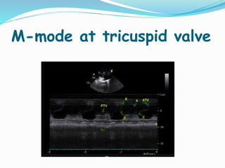 M-mode at tricuspid valve
 