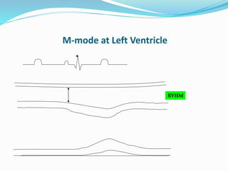 M-mode at Left Ventricle
RVIDd
 