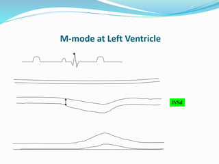 M-mode at Left Ventricle
IVSd
 