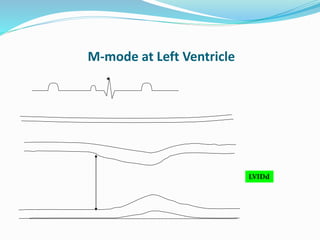 M-mode at Left Ventricle
LVIDd
 