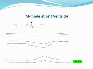 M-mode at Left Ventricle
LVPWd
 