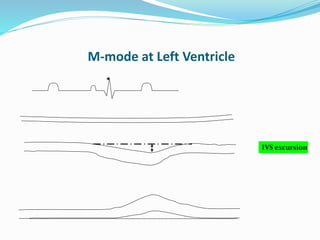 M-mode at Left Ventricle
IVS excursion
 
