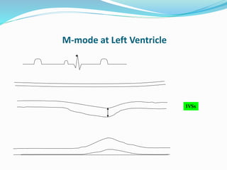 M-mode at Left Ventricle
IVSs
 