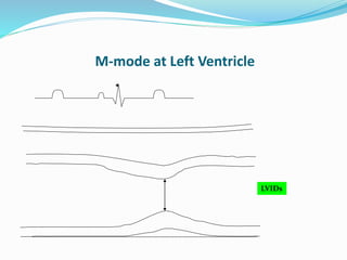 M-mode at Left Ventricle
LVIDs
 
