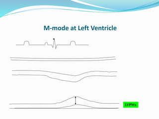 M-mode at Left Ventricle
LVPWs
 