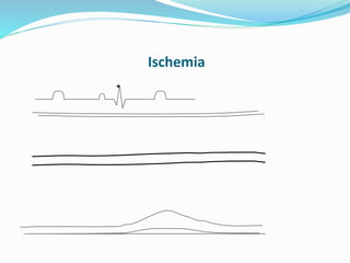 Ischemia
 