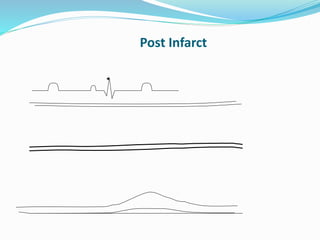 Post Infarct
 
